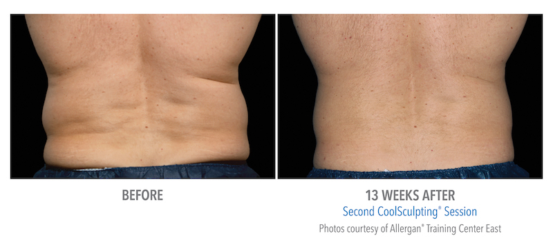CoolSculpting Before and After Male Love Handles