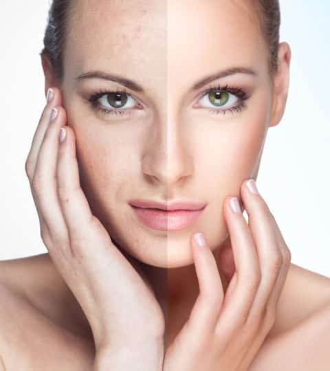 B.B.L Photofacial Before and After