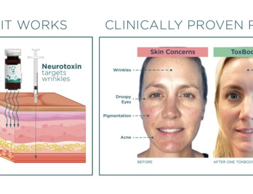The VI Peel Tox Booster: The Treatment That Enhances Your Botox Results!