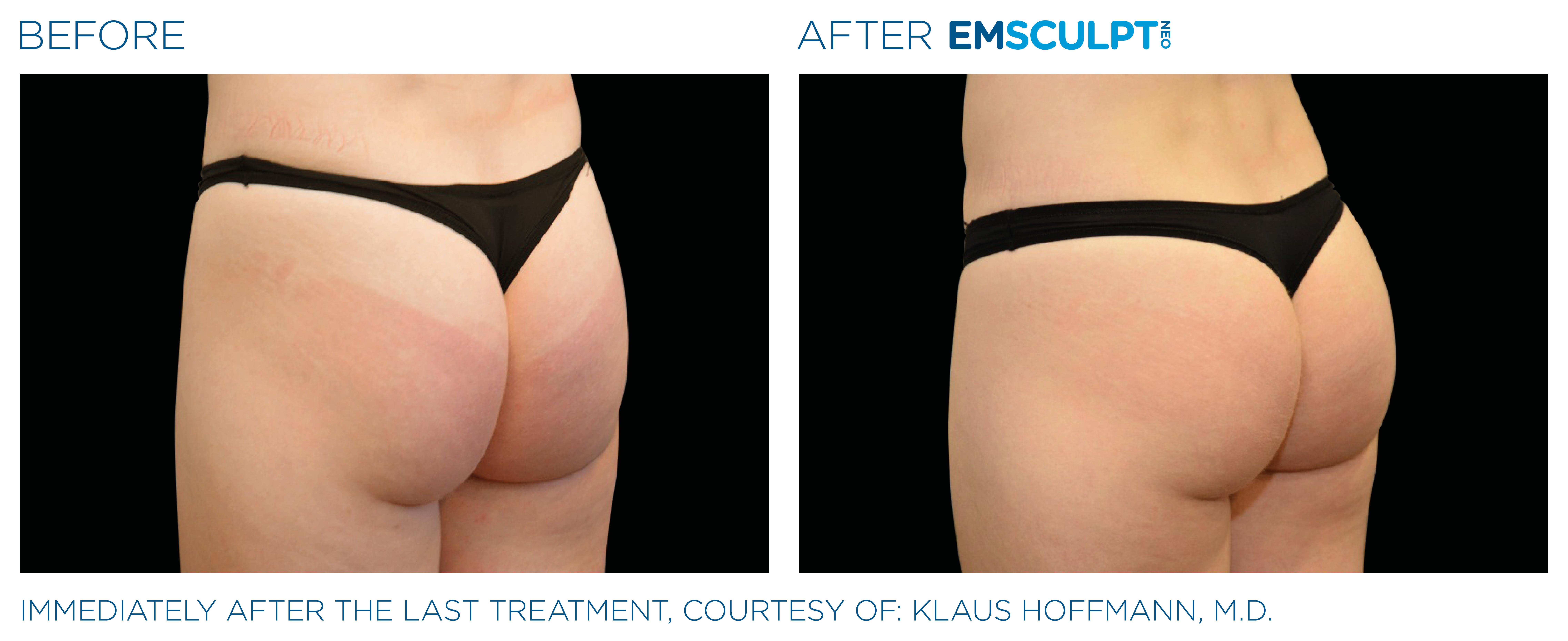 EmSculpt Treatment done in Austin, TX